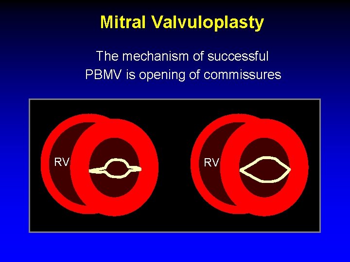 Mitral Valvuloplasty The mechanism of successful PBMV is opening of commissures RV RV 