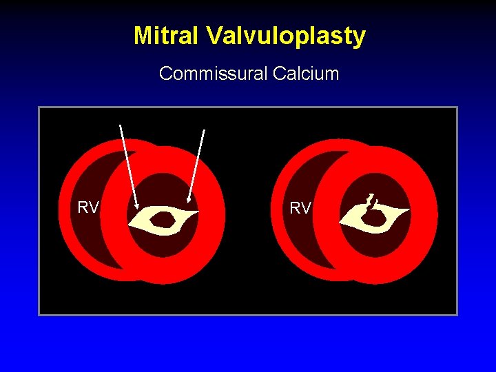 Mitral Valvuloplasty Commissural Calcium RV RV 