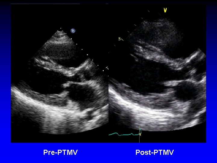 Pre-PTMV Post-PTMV 