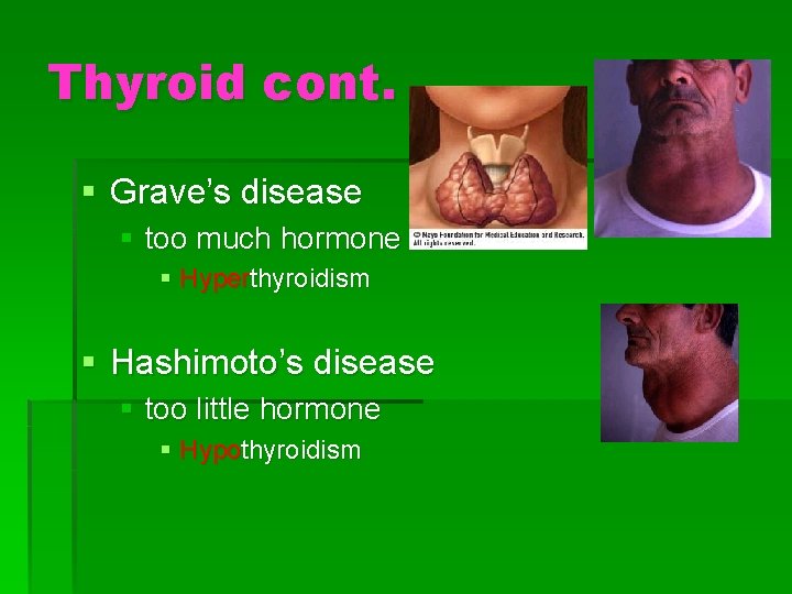 Thyroid cont. § Grave’s disease § too much hormone § Hyperthyroidism § Hashimoto’s disease Thyroid cont. § Grave’s disease § too much hormone § Hyperthyroidism § Hashimoto’s disease
