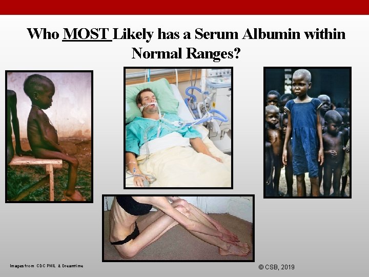 Who MOST Likely has a Serum Albumin within Normal Ranges? Images from CDC PHIL