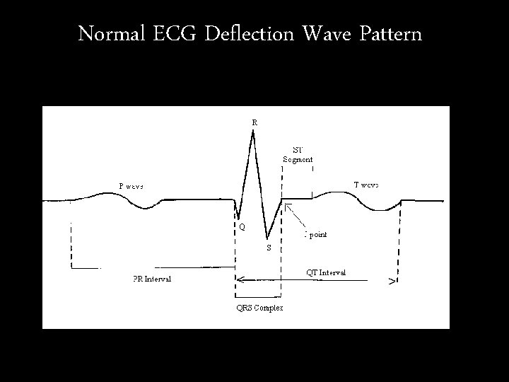 Normal ECG Deflection Wave Pattern Normal ECG Deflection Wave Pattern
