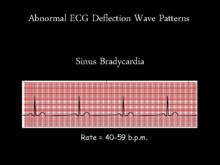 Abnormal ECG Deflection Wave Patterns Sinus Bradycardia Rate = 40 -59 b. p. m. Abnormal ECG Deflection Wave Patterns Sinus Bradycardia Rate = 40 -59 b. p. m.