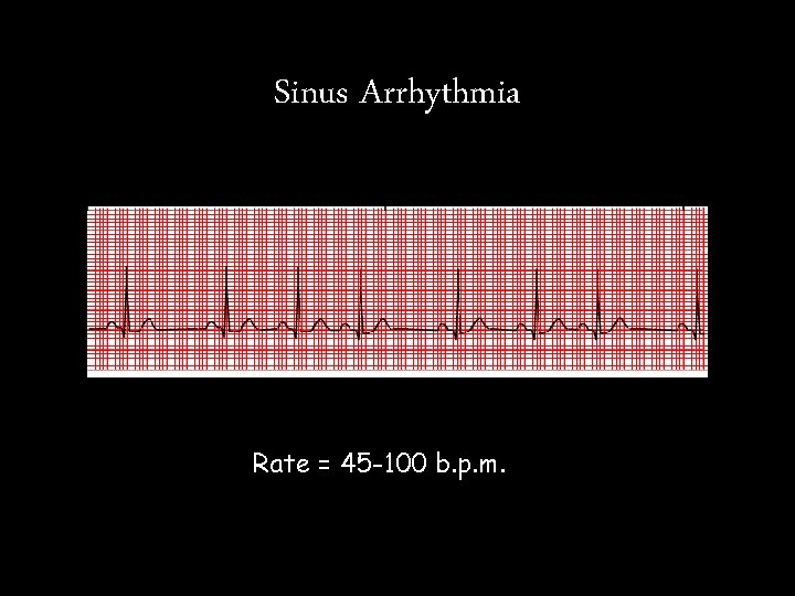Sinus Arrhythmia Rate = 45 -100 b. p. m. Sinus Arrhythmia Rate = 45 -100 b. p. m.