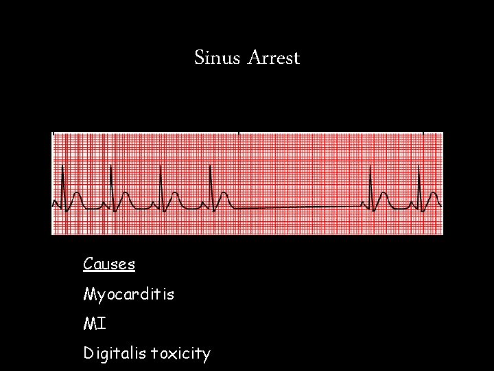 Sinus Arrest Causes Myocarditis MI Digitalis toxicity Sinus Arrest Causes Myocarditis MI Digitalis toxicity