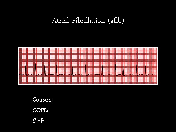 Atrial Fibrillation (afib) Causes COPD CHF Atrial Fibrillation (afib) Causes COPD CHF