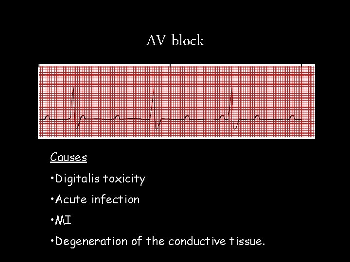 AV block Causes • Digitalis toxicity • Acute infection • MI • Degeneration of AV block Causes • Digitalis toxicity • Acute infection • MI • Degeneration of