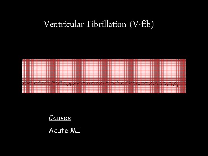 Ventricular Fibrillation (V-fib) Causes Acute MI Ventricular Fibrillation (V-fib) Causes Acute MI
