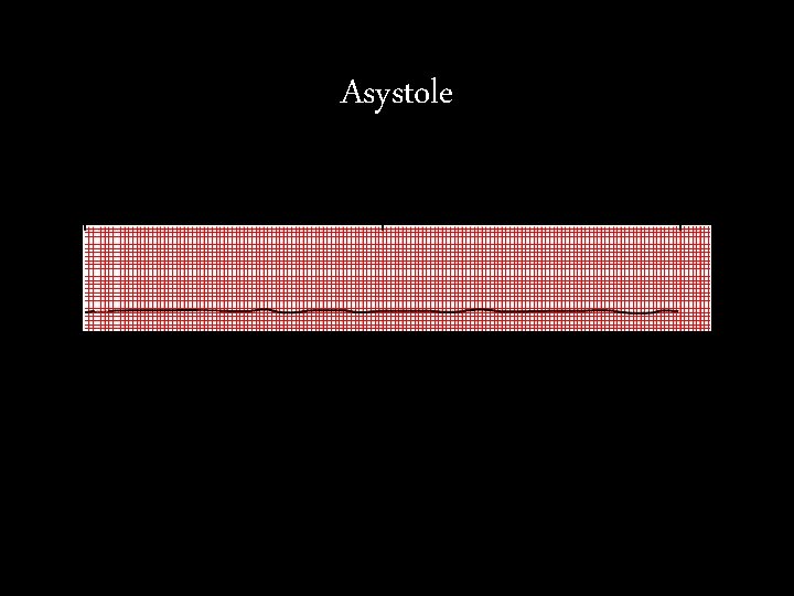 Asystole Asystole