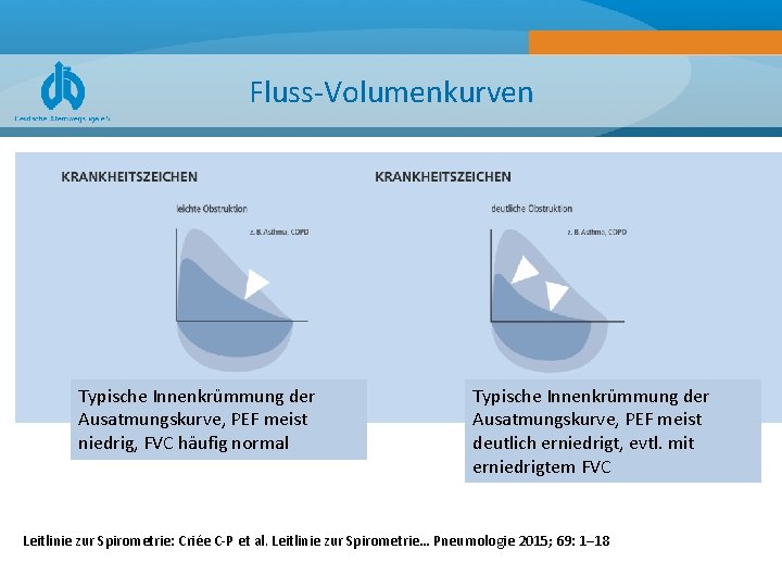 Fluss-Volumenkurven Typische Innenkrümmung der Ausatmungskurve, PEF meist niedrig, FVC häufig normal Typische Innenkrümmung der