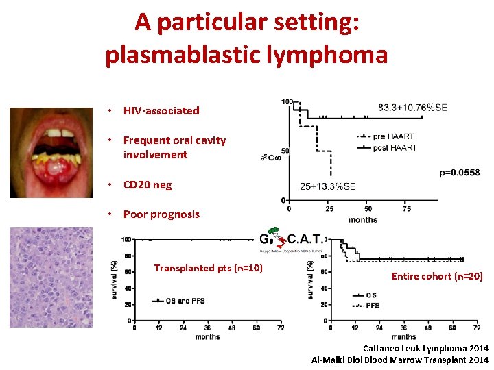 A particular setting: plasmablastic lymphoma • HIV-associated • Frequent oral cavity involvement • CD