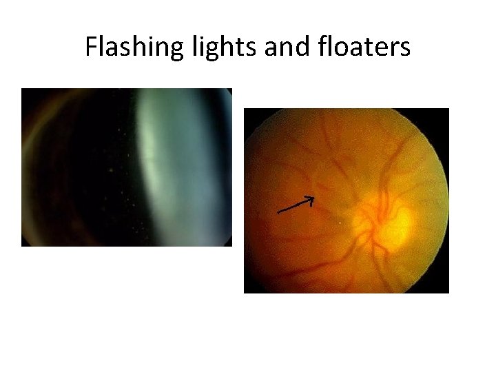 Flashing lights and floaters 