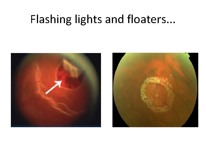 Flashing lights and floaters. . . 