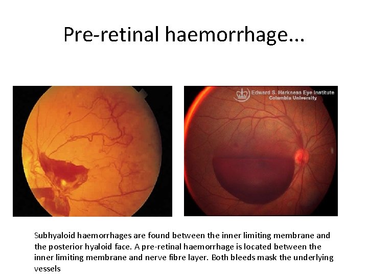 Pre-retinal haemorrhage. . . Subhyaloid haemorrhages are found between the inner limiting membrane and