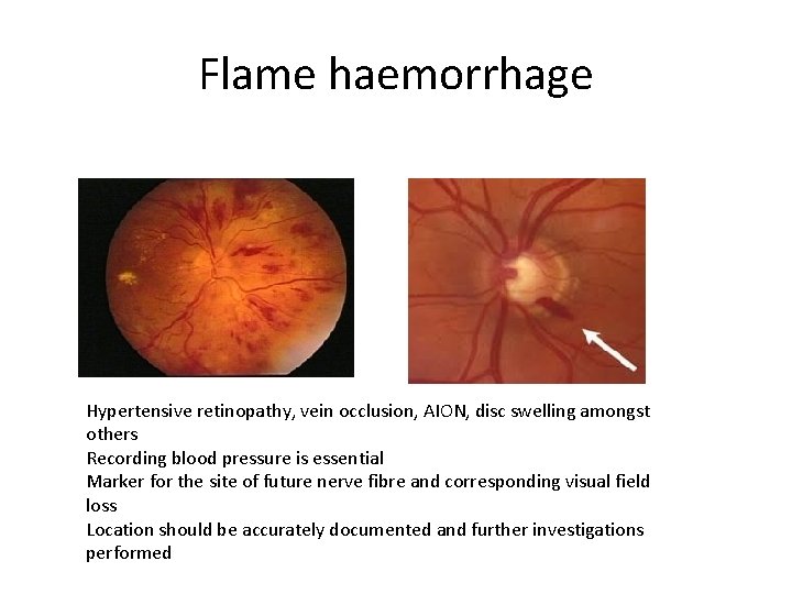 Flame haemorrhage Hypertensive retinopathy, vein occlusion, AION, disc swelling amongst others Recording blood pressure