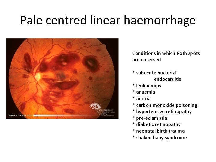Pale centred linear haemorrhage Conditions in which Roth spots are observed * subacute bacterial