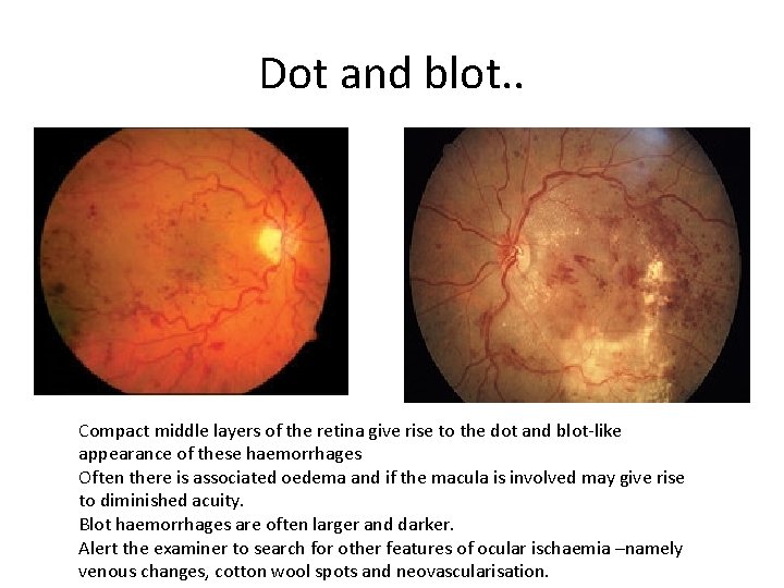 Dot and blot. . Compact middle layers of the retina give rise to the