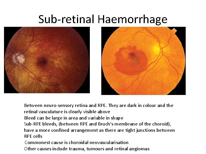 Sub-retinal Haemorrhage Between neuro-sensory retina and RPE. They are dark in colour and the