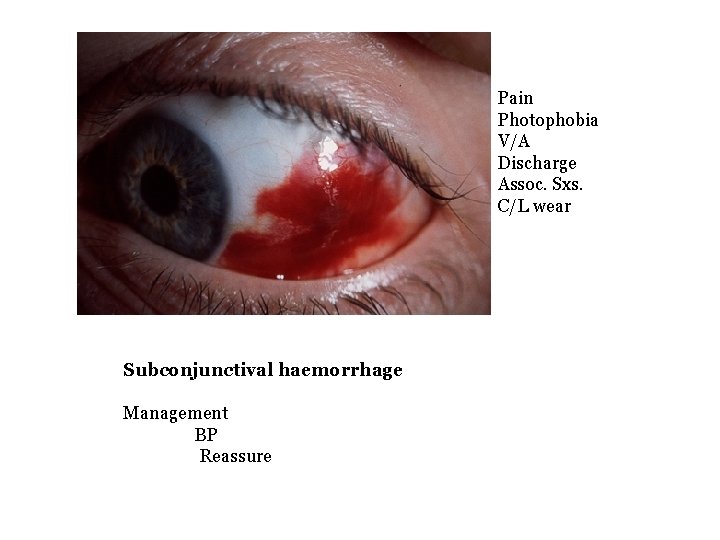 Pain Photophobia V/A Discharge Assoc. Sxs. C/L wear Subconjunctival haemorrhage Management BP Reassure 