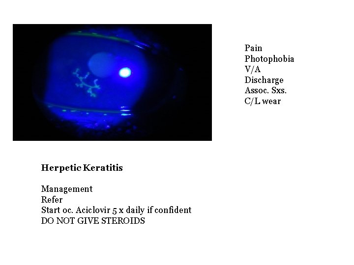 Pain Photophobia V/A Discharge Assoc. Sxs. C/L wear Herpetic Keratitis Management Refer Start oc.
