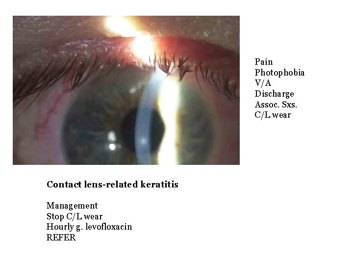 Pain Photophobia V/A Discharge Assoc. Sxs. C/L wear Contact lens-related keratitis Management Stop C/L
