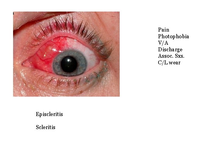 Pain Photophobia V/A Discharge Assoc. Sxs. C/L wear Episcleritis Scleritis 