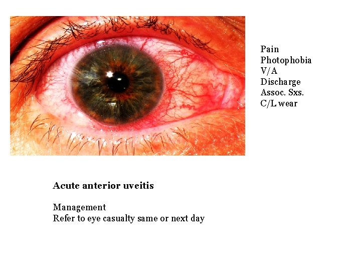 Pain Photophobia V/A Discharge Assoc. Sxs. C/L wear Acute anterior uveitis Management Refer to