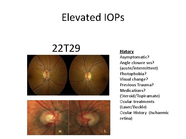 Elevated IOPs 22 T 29 History Asymptomatic? Angle closure sxs? (acute/intermittent) Photophobia? Visual change?
