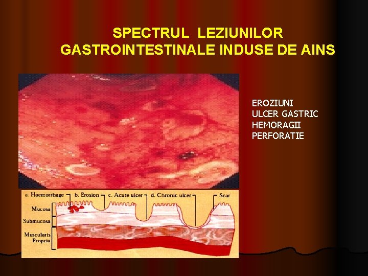 SPECTRUL LEZIUNILOR GASTROINTESTINALE INDUSE DE AINS EROZIUNI ULCER GASTRIC HEMORAGII PERFORATIE 