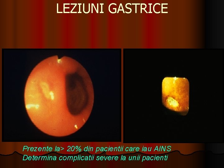 LEZIUNI GASTRICE Prezente la> 20% din pacientii care iau AINS Determina complicatii severe la