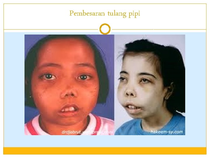 Pembesaran tulang pipi 