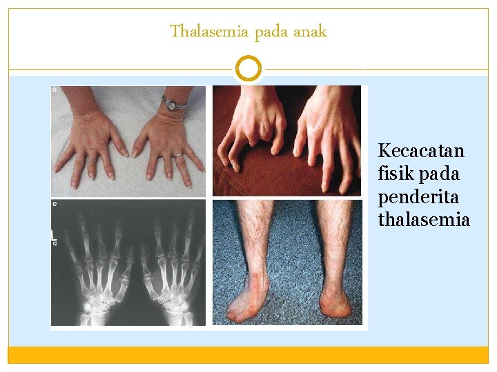 Thalasemia pada anak Kecacatan fisik pada penderita thalasemia 