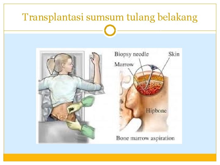 Transplantasi sumsum tulang belakang 