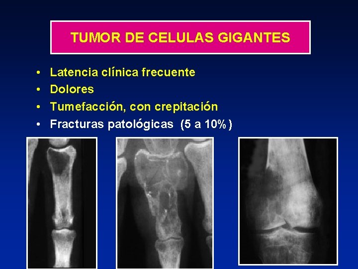 TUMOR DE CELULAS GIGANTES • • Latencia clínica frecuente Dolores Tumefacción, con crepitación Fracturas