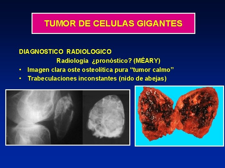 TUMOR DE CELULAS GIGANTES DIAGNOSTICO RADIOLOGICO Radiología ¿pronóstico? (MÉARY) • Imagen clara osteolítica pura