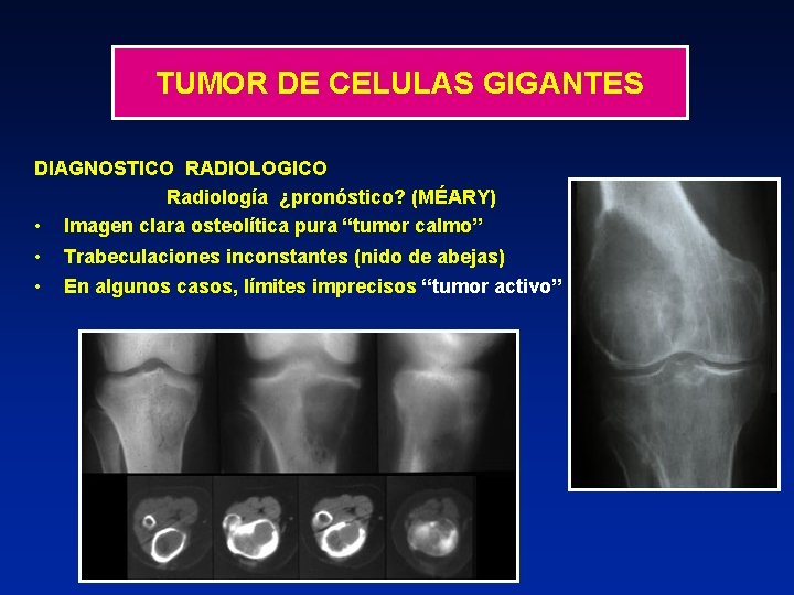 TUMOR DE CELULAS GIGANTES DIAGNOSTICO RADIOLOGICO Radiología ¿pronóstico? (MÉARY) • Imagen clara osteolítica pura