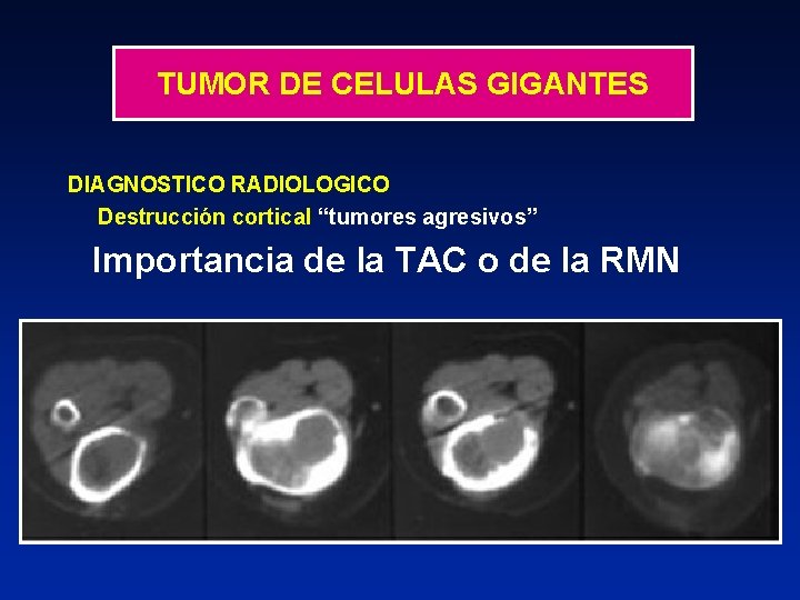 TUMOR DE CELULAS GIGANTES DIAGNOSTICO RADIOLOGICO Destrucción cortical “tumores agresivos” Importancia de la TAC