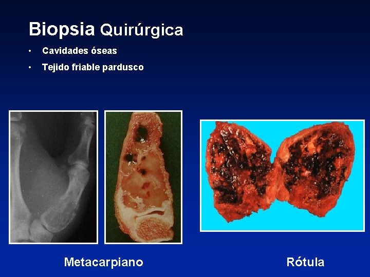 Biopsia Quirúrgica • Cavidades óseas • Tejido friable pardusco Metacarpiano Rótula 