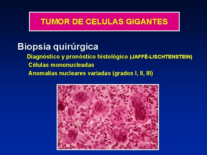 TUMOR DE CELULAS GIGANTES Biopsia quirúrgica Diagnóstico y pronóstico histológico (JAFFÉ-LISCHTENSTEIN) Células mononucleadas Anomalías