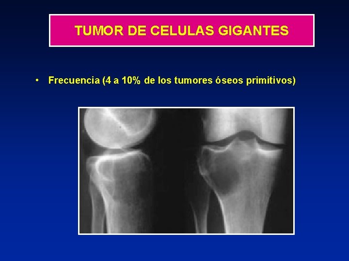 TUMOR DE CELULAS GIGANTES • Frecuencia (4 a 10% de los tumores óseos primitivos)