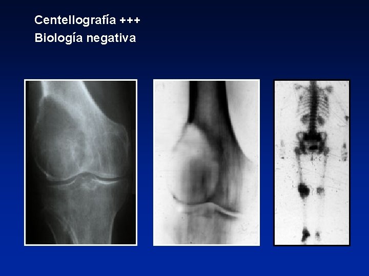 Centellografía +++ Biología negativa 