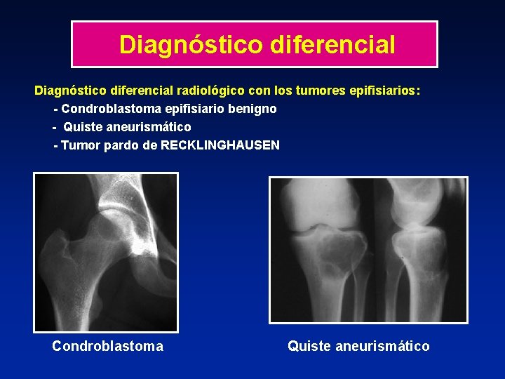 Diagnóstico diferencial radiológico con los tumores epifisiarios: - Condroblastoma epifisiario benigno - Quiste aneurismático