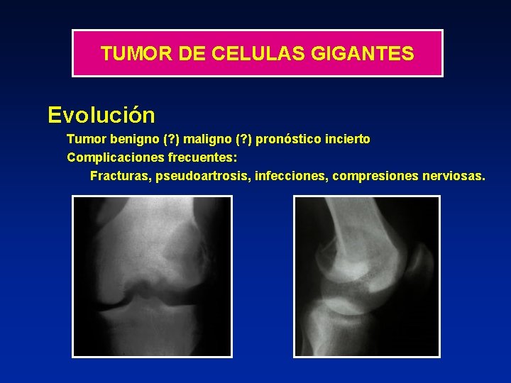 TUMOR DE CELULAS GIGANTES Evolución Tumor benigno (? ) maligno (? ) pronóstico incierto