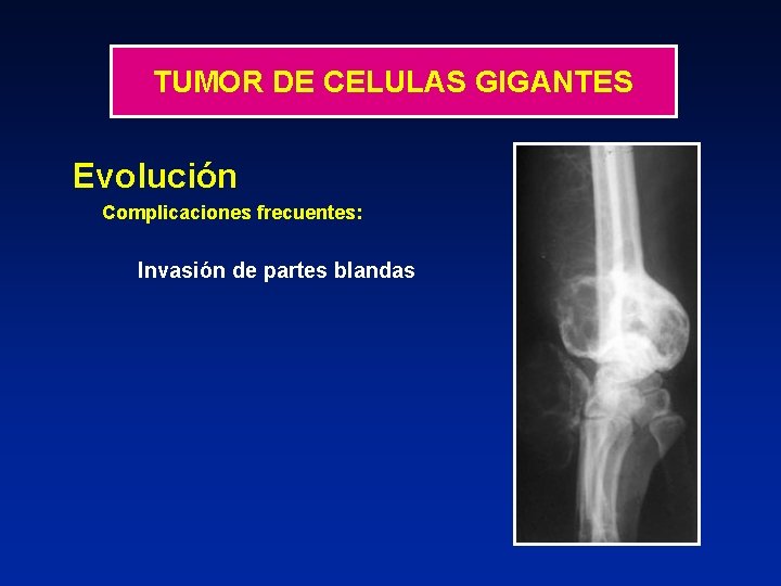 TUMOR DE CELULAS GIGANTES Evolución Complicaciones frecuentes: Invasión de partes blandas 