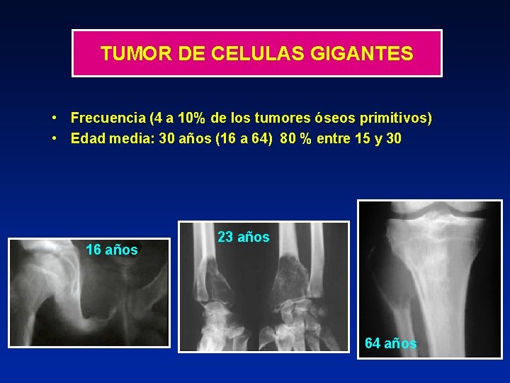 TUMOR DE CELULAS GIGANTES • Frecuencia (4 a 10% de los tumores óseos primitivos)