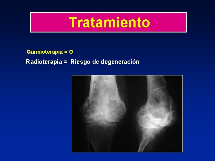 Tratamiento Quimioterapia = O Radioterapia = Riesgo de degeneración 