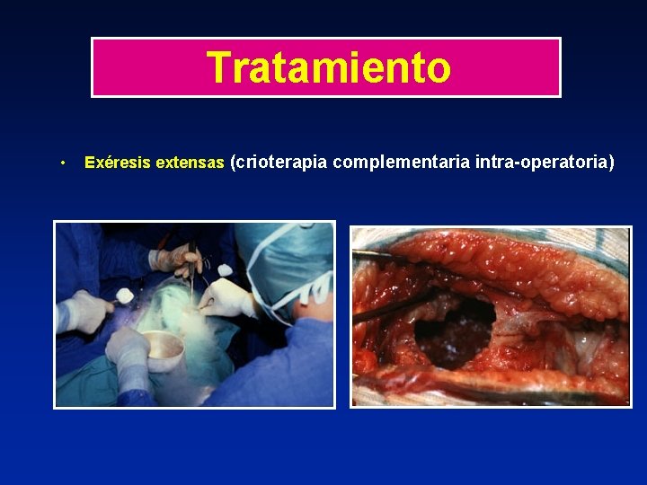 Tratamiento • Exéresis extensas (crioterapia complementaria intra-operatoria) 
