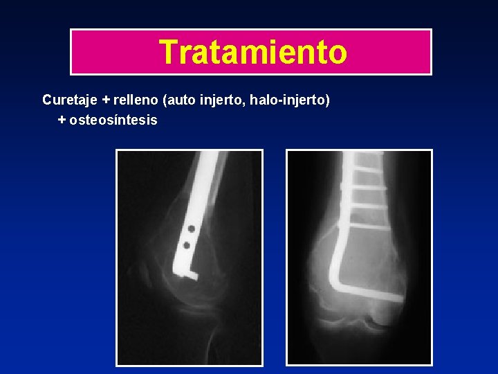 Tratamiento Curetaje + relleno (auto injerto, halo-injerto) + osteosíntesis 