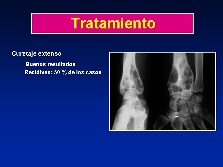 Tratamiento Curetaje extenso Buenos resultados Recidivas: 50 % de los casos 