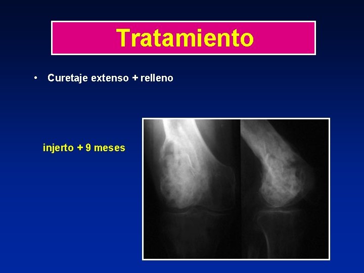 Tratamiento • Curetaje extenso + relleno injerto + 9 meses 